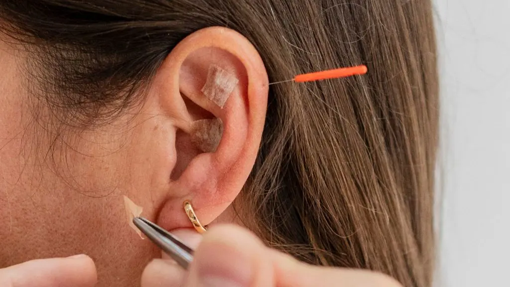 aplicación de auriculoterapia en la oreja con aguja y puntos terapéuticos para mejorar el bienestar físico y emocional